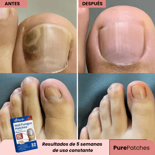 PARCHES ANTI-HONGOS PARA UÑAS