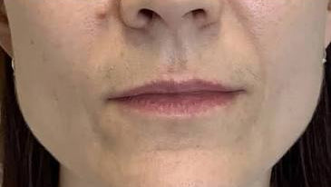 Antes
